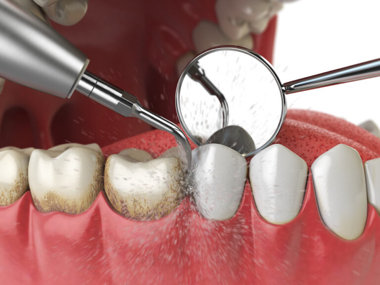 What Is A Dental Cleaning