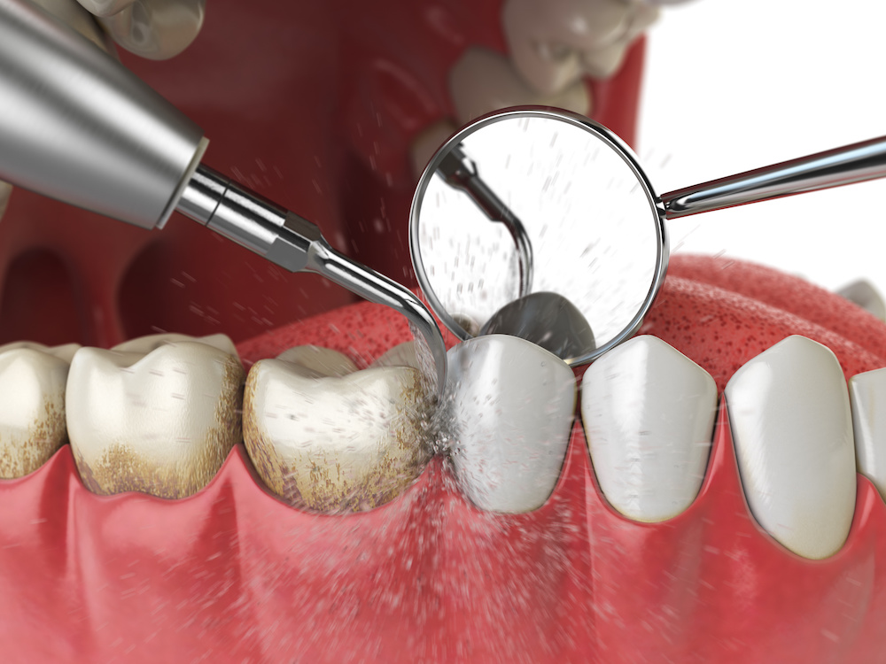 What Is A Dental Cleaning