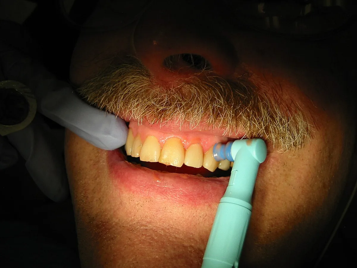 dental hygienist polishing teeth