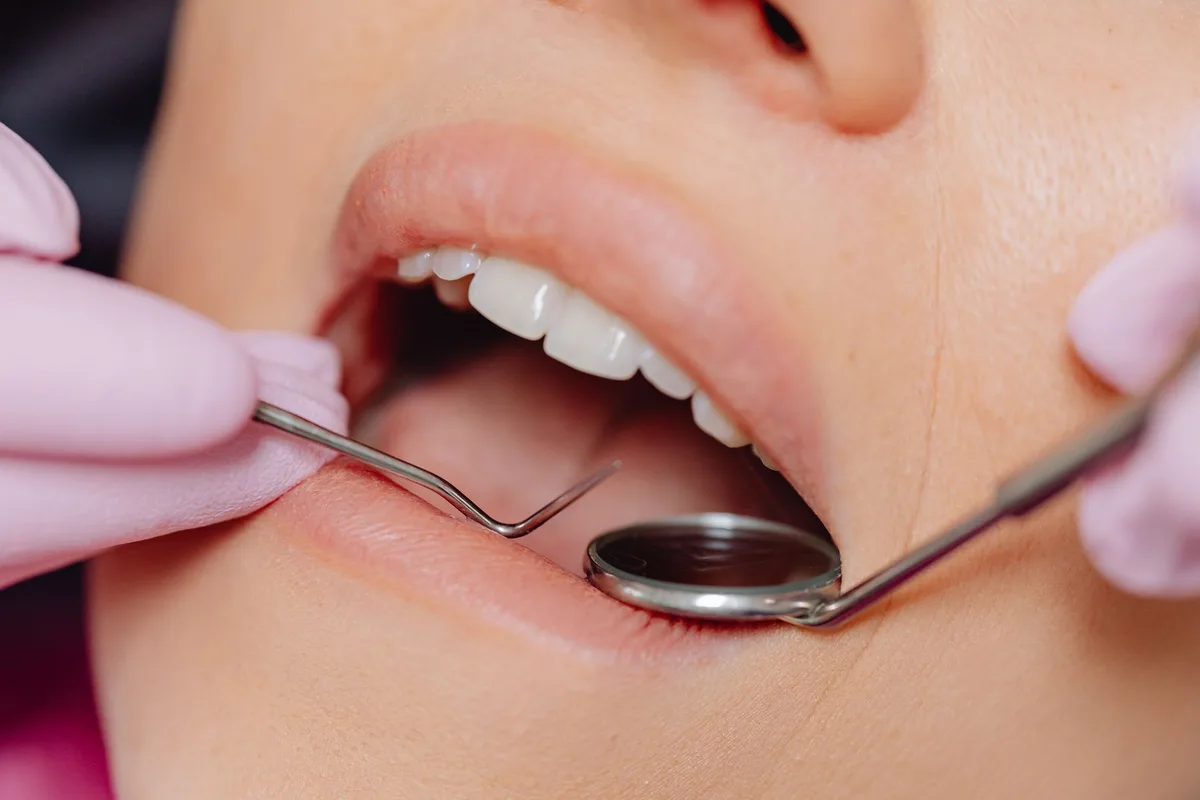 dental plaque and tartar removal
