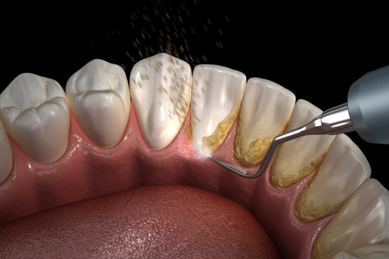 What Is A Dental Cleaning Procedure