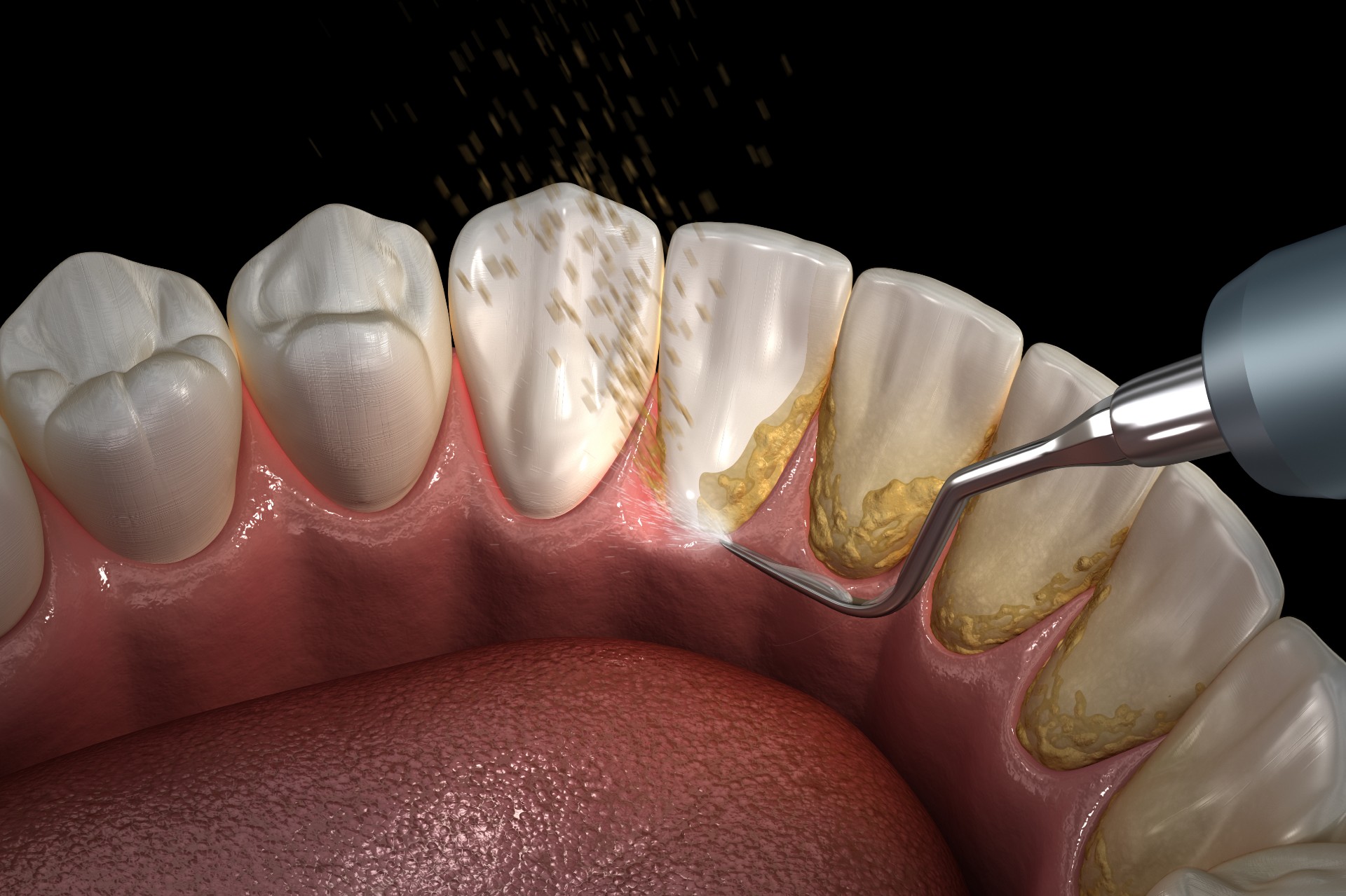 What Is A Dental Cleaning Procedure